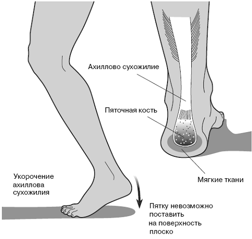 Все о здоровье ваших ног. От младенчества до старости pic_12.png