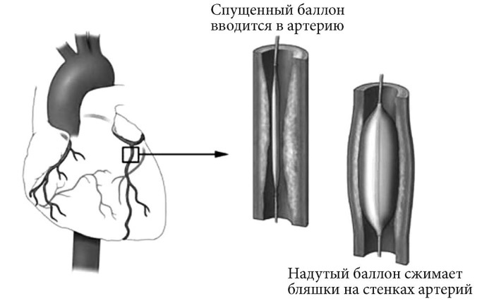Лучшие методы лечения и профилактики инфаркта миокарда i_013.jpg