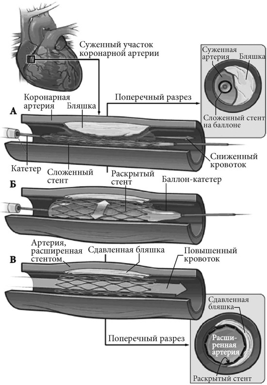 Лучшие методы лечения и профилактики инфаркта миокарда i_014.jpg
