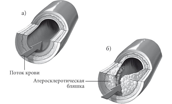 Лучшие методы лечения и профилактики инфаркта миокарда i_009.jpg